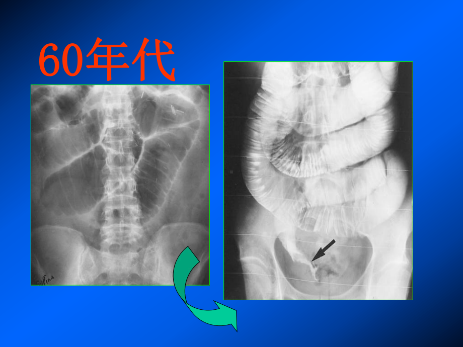 胃肠道影像检查技术的发展课件.ppt_第2页