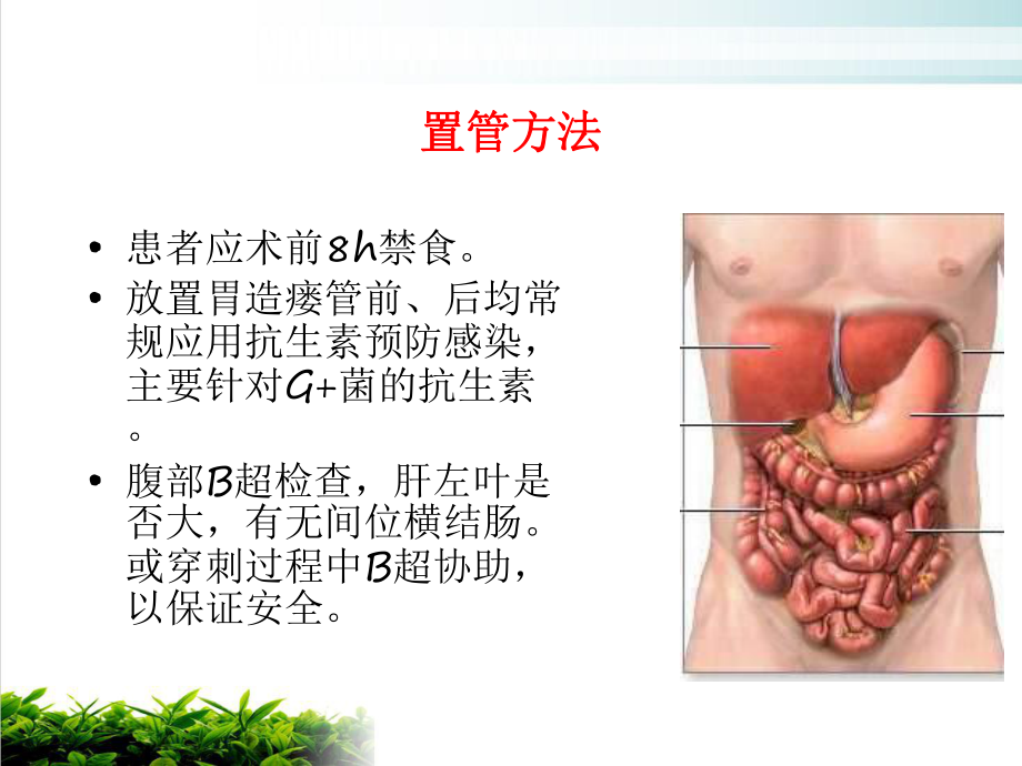 经皮胃镜下胃造瘘术操作与术后护理课件.pptx_第2页