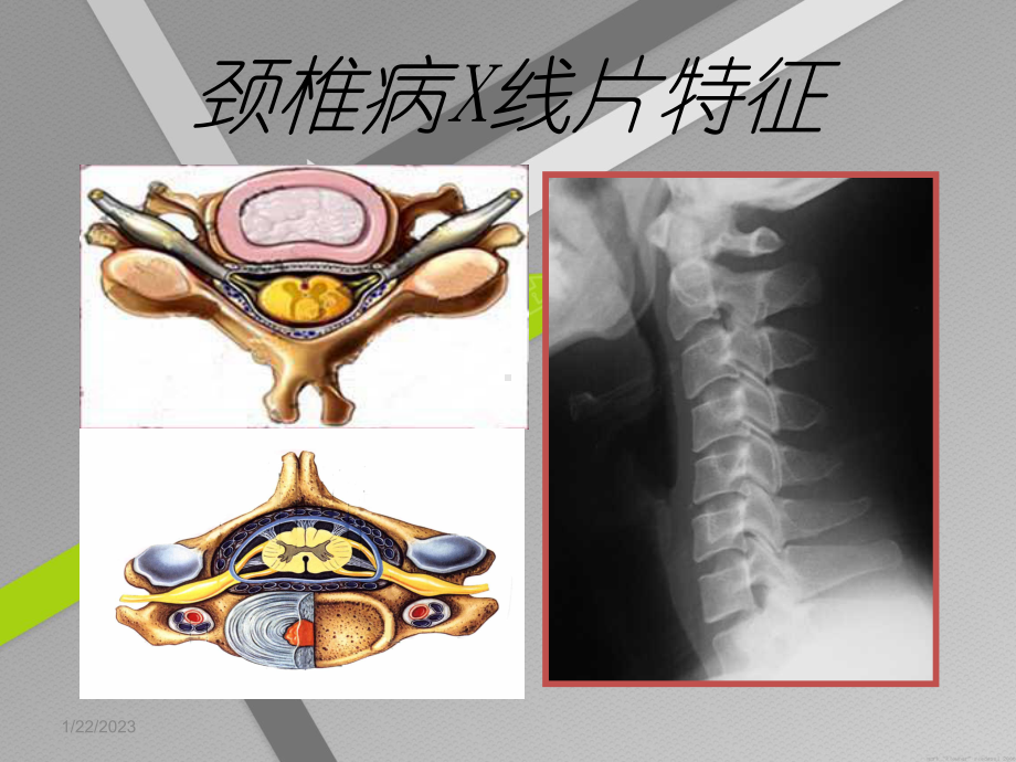 神经根性颈椎病课件.pptx_第2页