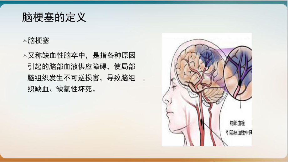 脑梗塞护理查房优质课件.pptx_第2页