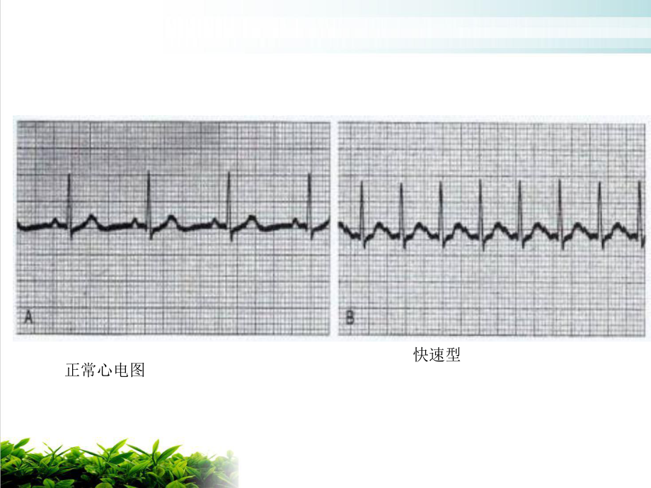 第三节抗心律失常药优质课件.ppt_第3页