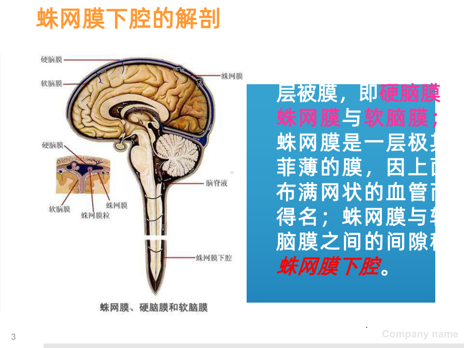 神外2：一例蛛网膜下腔出血患者护理查房课件.ppt_第3页