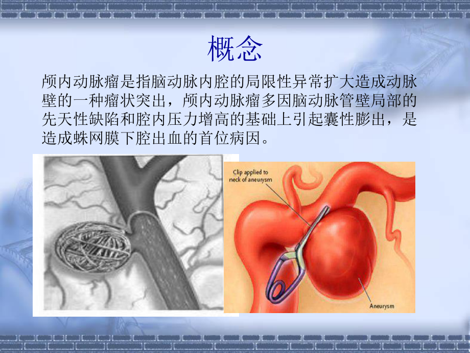 脑动脉瘤夹闭术课件.ppt_第2页