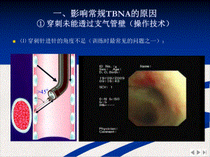 经支气管针吸活检技术操作事项完美版课件.pptx