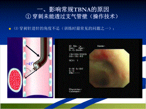 经支气管针吸活检技术操作事项课件.pptx