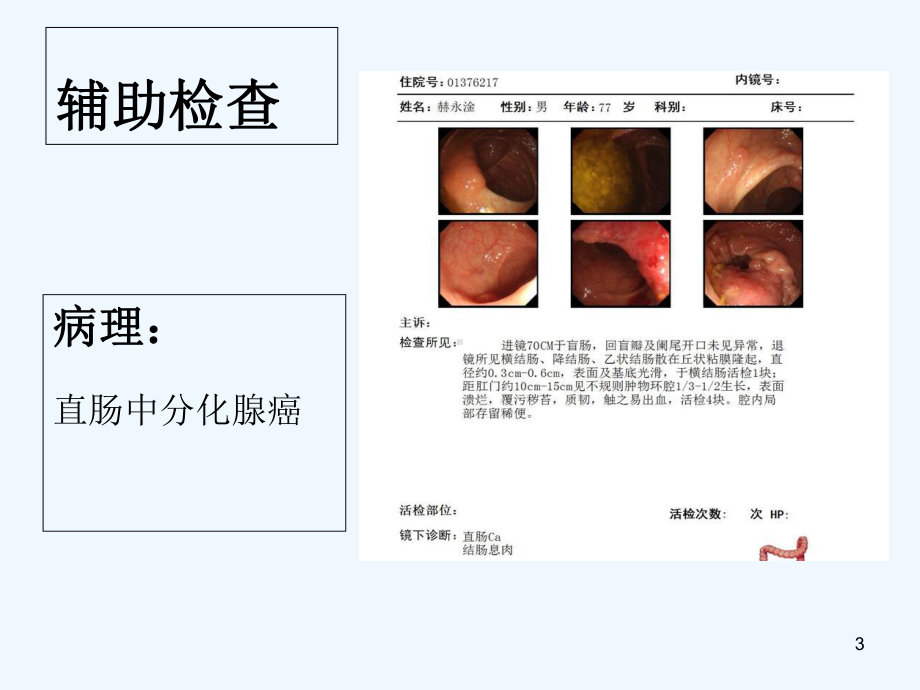 直肠癌术后吻合口出血-课件.ppt_第3页