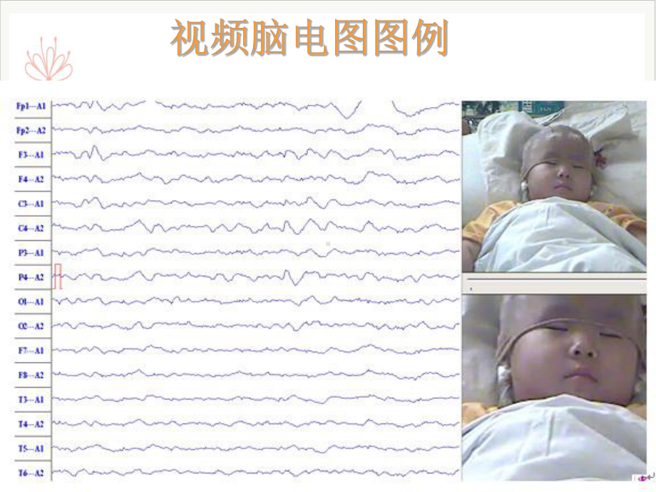 脑电图基础课件.ppt_第2页