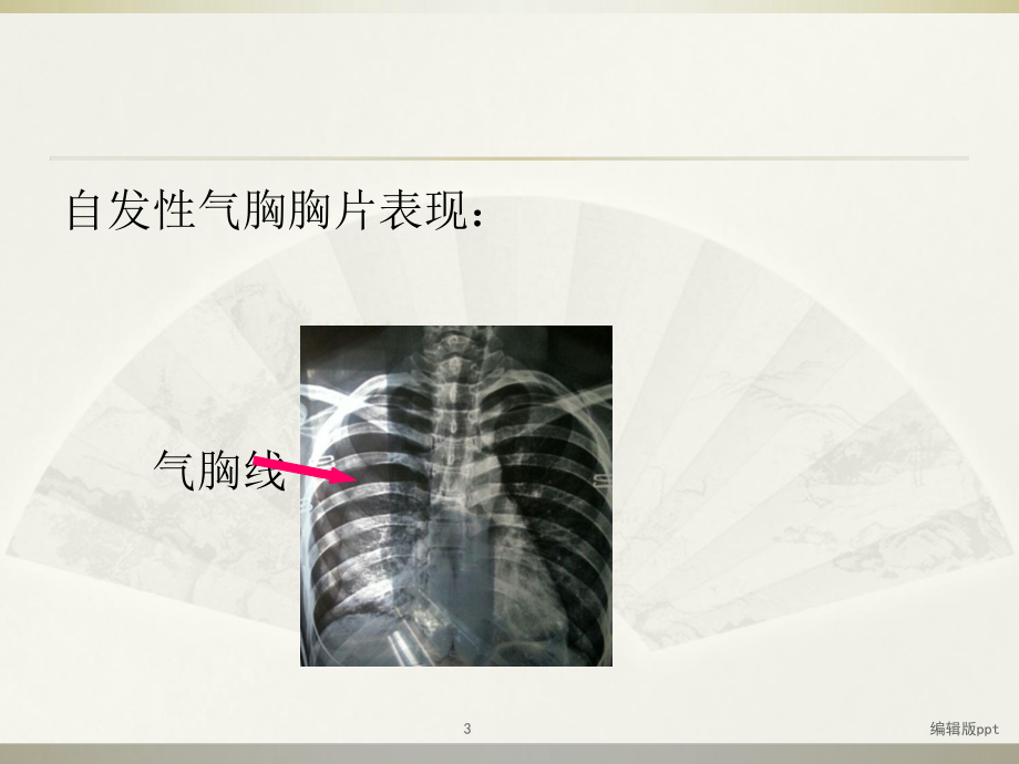 胸外科展板常见病课件.ppt_第3页