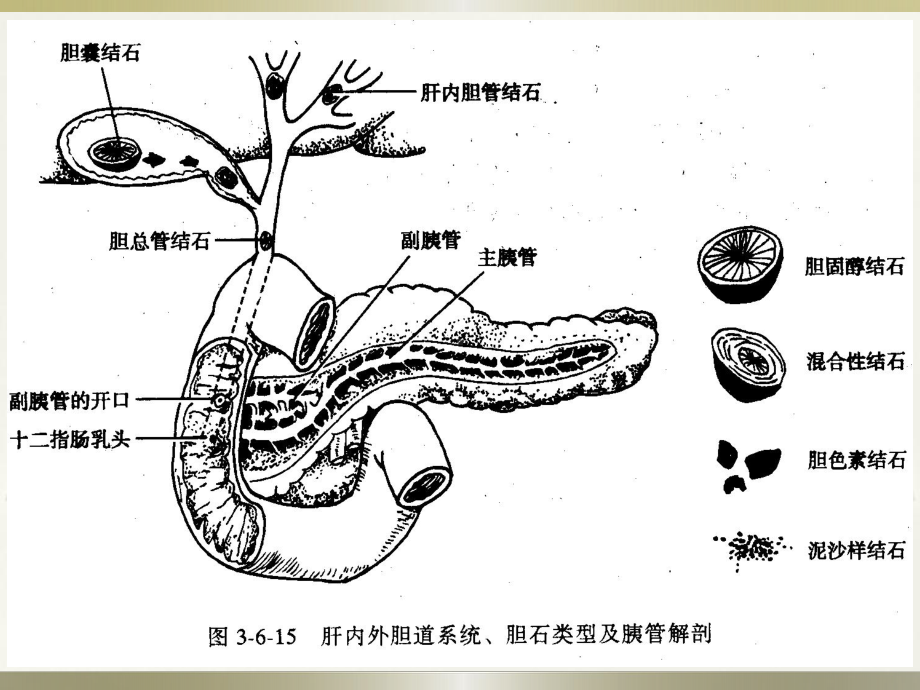 胆道感染与胆石症病人的护理课件.ppt_第3页