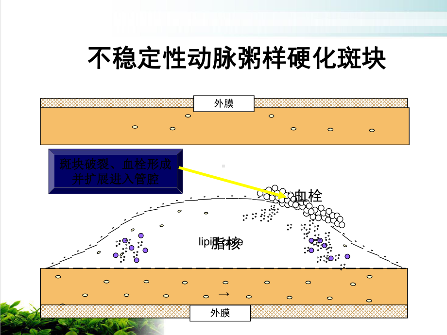 稳定性冠心病处理课件.ppt_第3页