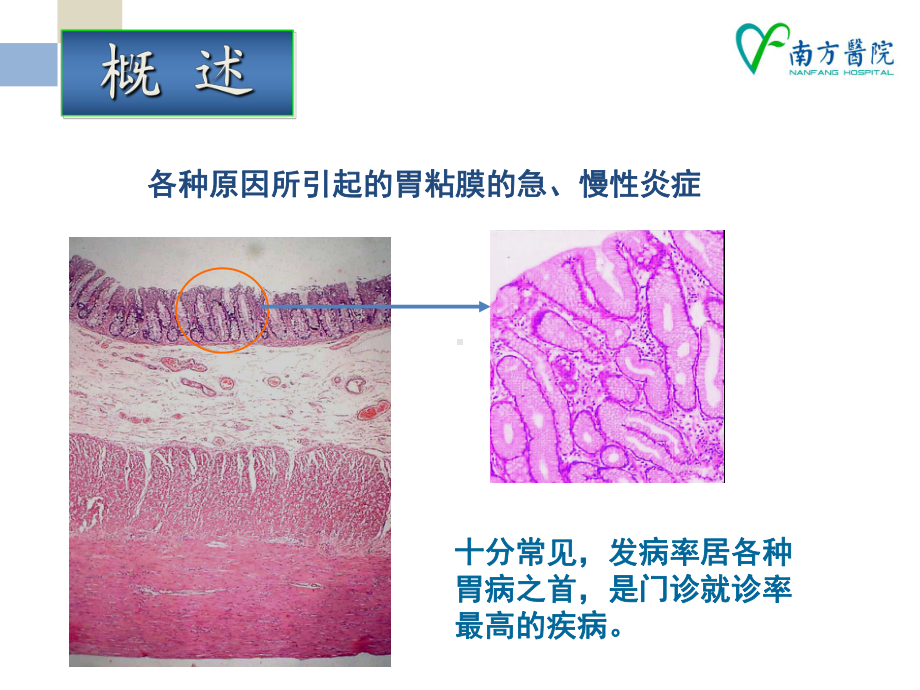 胃炎临床诊疗课件.pptx_第2页