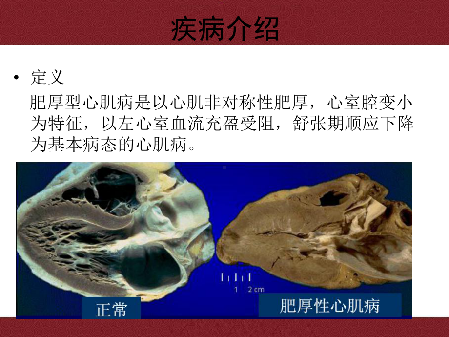 肥厚型梗阻性心肌病护理查房课件讲义.ppt_第3页