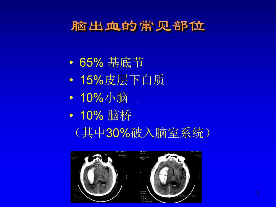 脑出血的现状课件.ppt_第3页