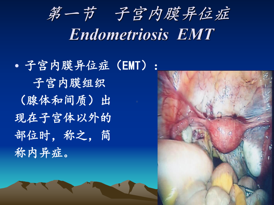 盆腔子宫内膜异位症完整版课件.pptx_第3页