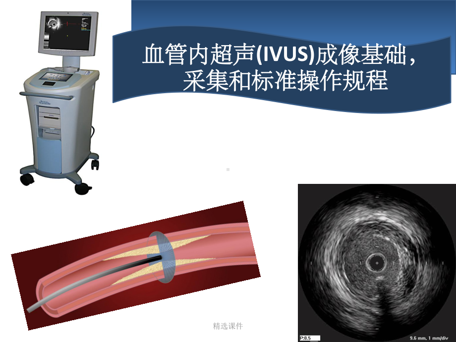 血管内超声IVUS简介课件整理.ppt_第1页