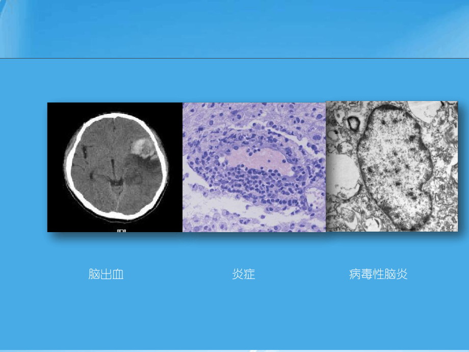 病毒性脑炎诊断的困惑课件.ppt_第2页