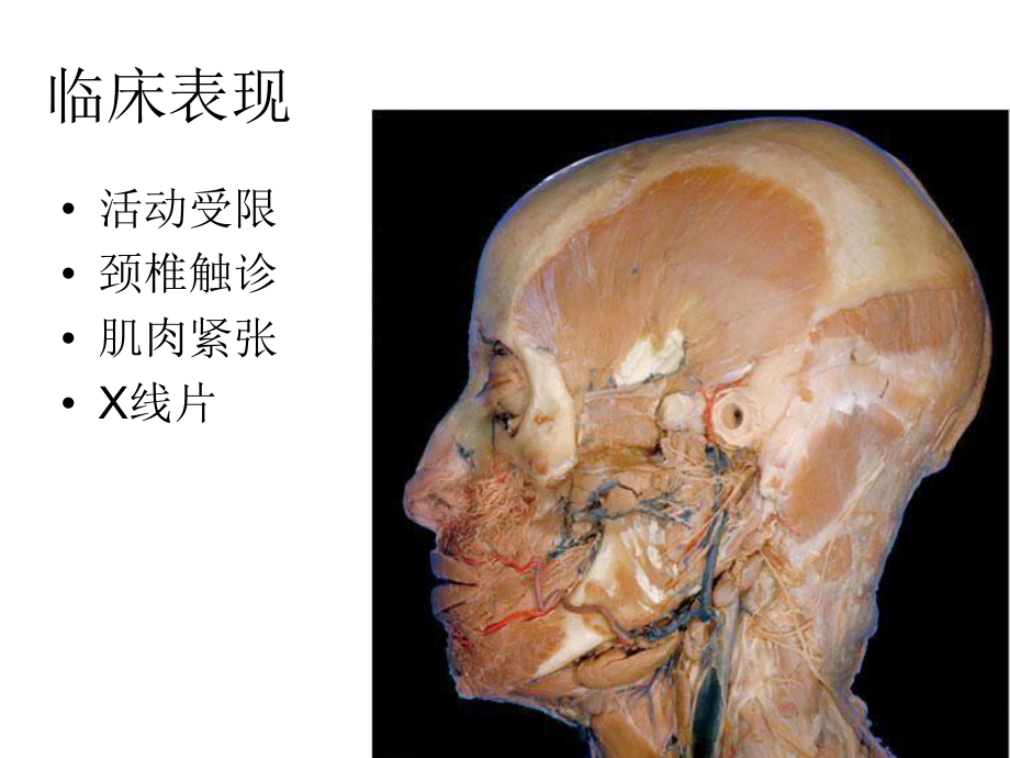 脊柱相关疾病头痛课件.ppt_第2页