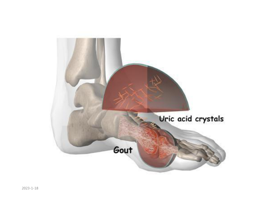 痛风性关节炎课件(同名45).ppt_第3页