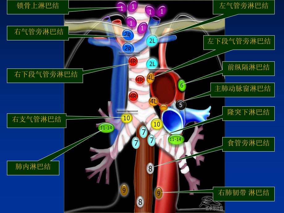 肺癌纵膈肺门淋巴结分区及CT图像医学课件.ppt_第3页