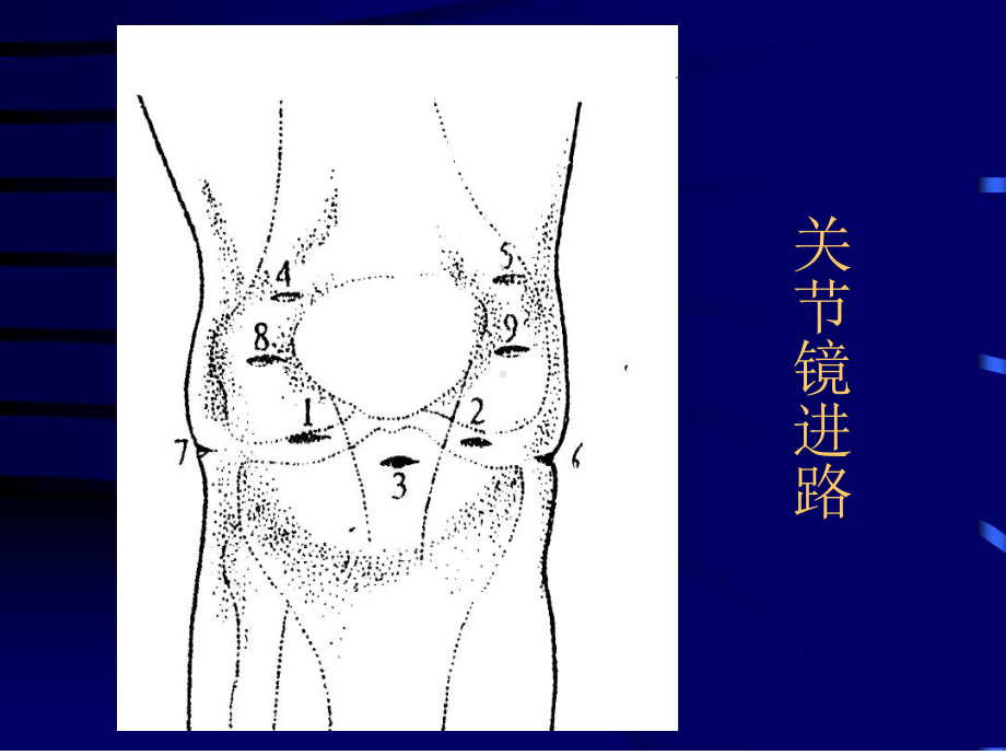 膝关节镜检查和治疗课件.ppt_第3页