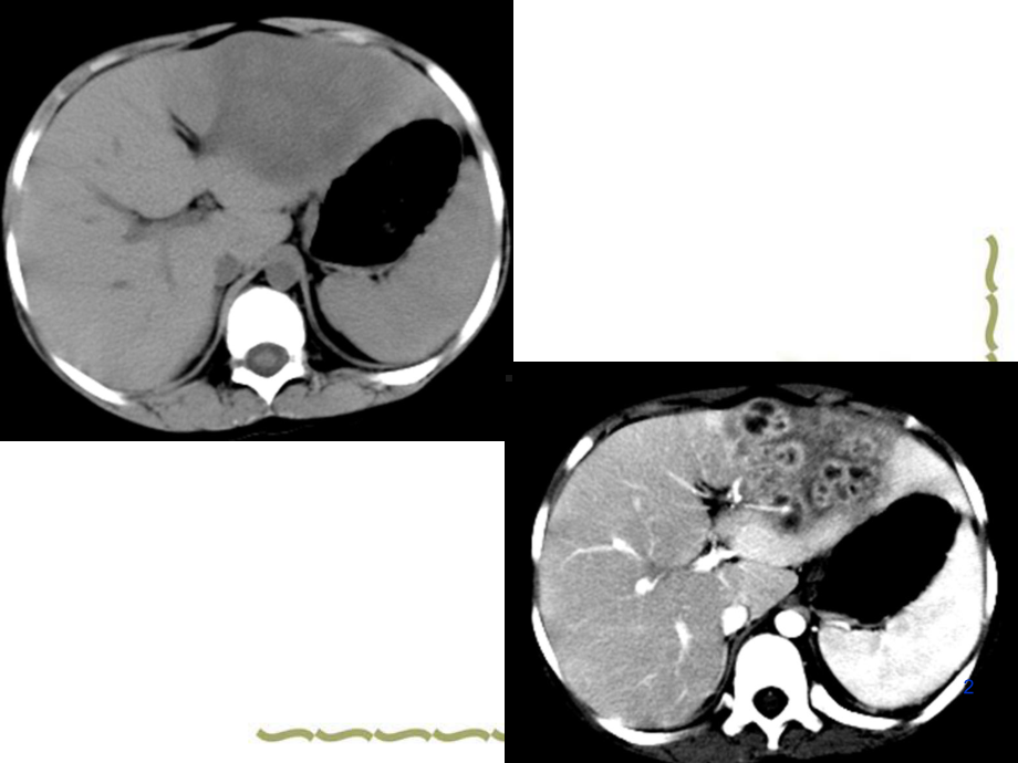 系列病例报告~肝脓肿课件.ppt_第2页