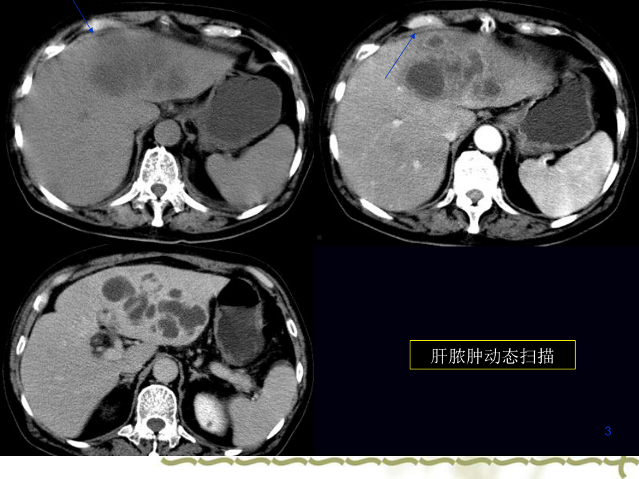 系列病例报告~肝脓肿课件.ppt_第3页