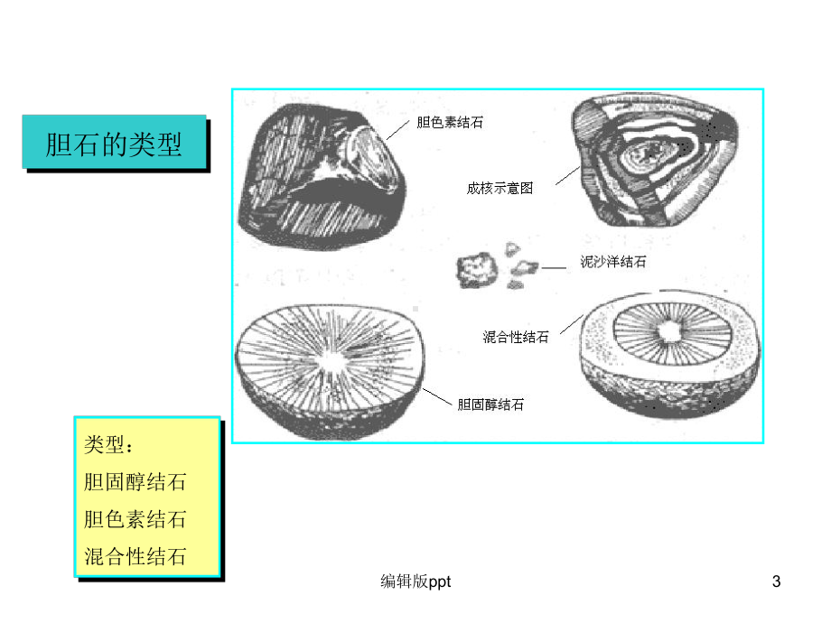 胆道疾病-最新课件.ppt_第3页