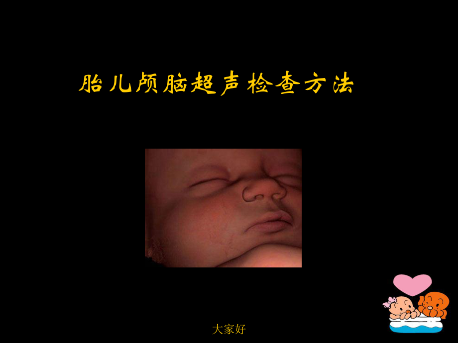 胎儿中枢神经系统的超声检查-课件.ppt_第3页