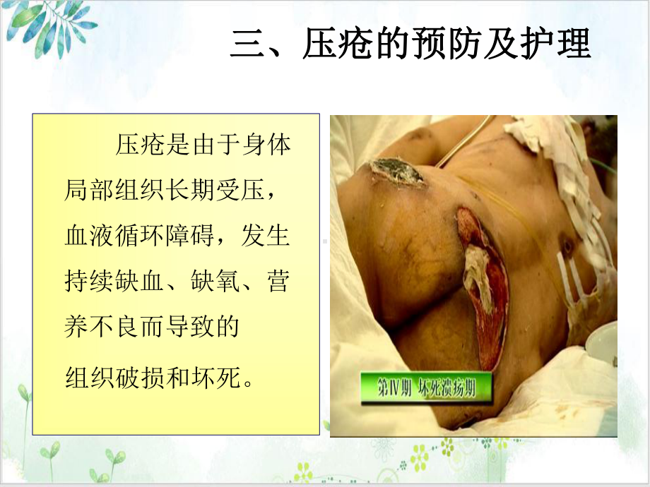 病人清洁的护理-压疮实用课件.ppt_第2页