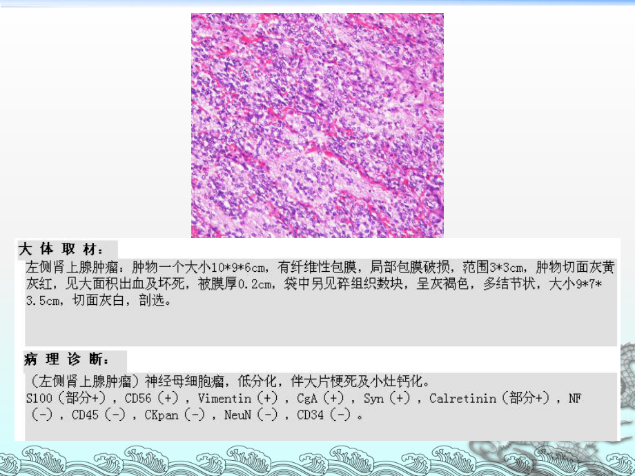 肾上腺神经母细胞瘤影像诊断与鉴别诊断课件整理-002.ppt_第2页