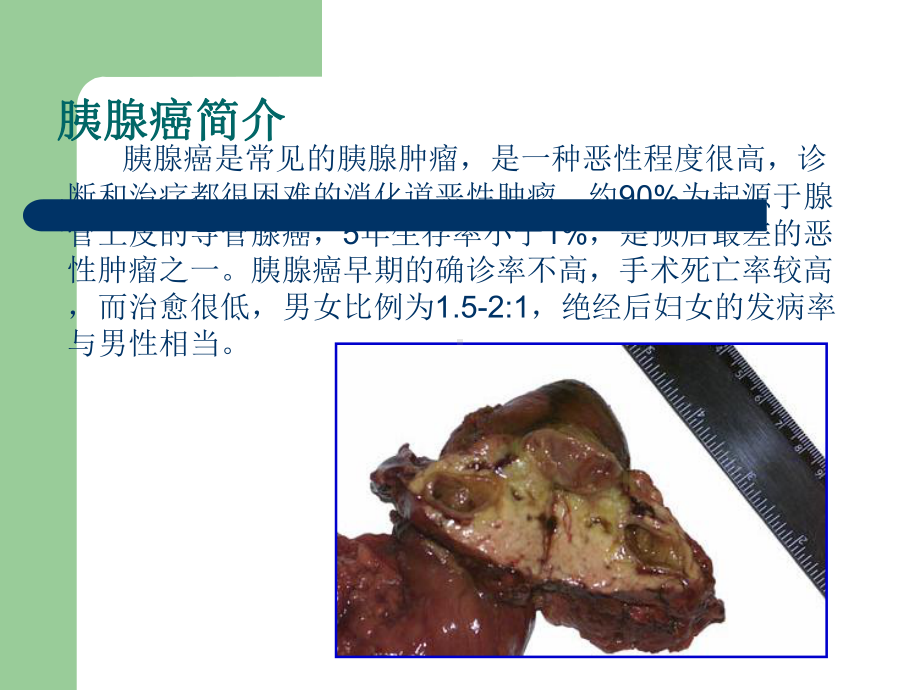 胰腺癌围手术期护理课件.ppt_第3页