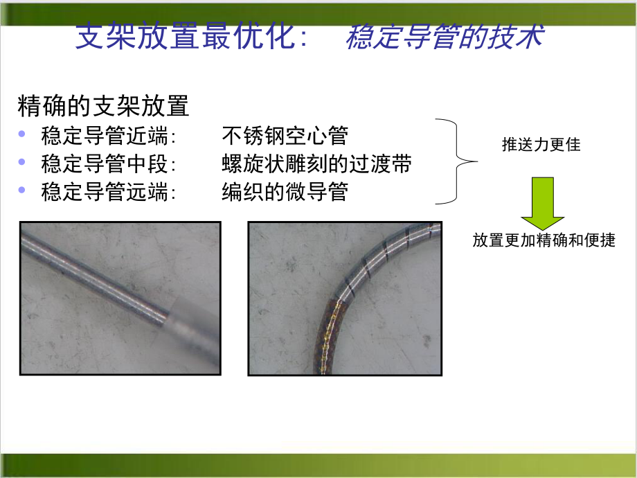 神经介入支架植入术选择课件.pptx_第2页