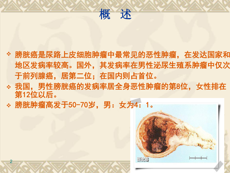 膀胱肿瘤病人的护理课件(同名149).ppt_第2页