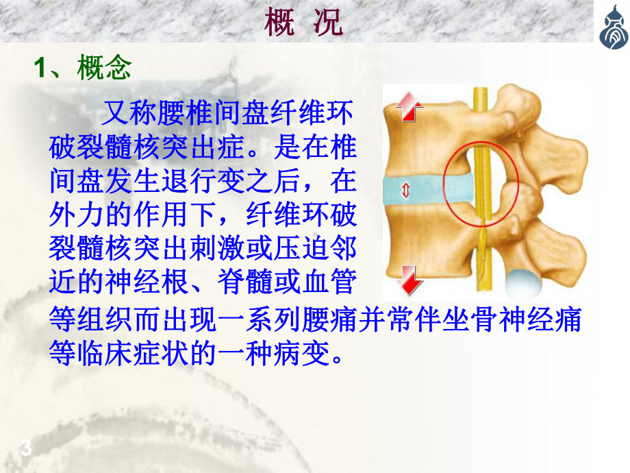 腰椎间盘突出症m课件.ppt_第3页