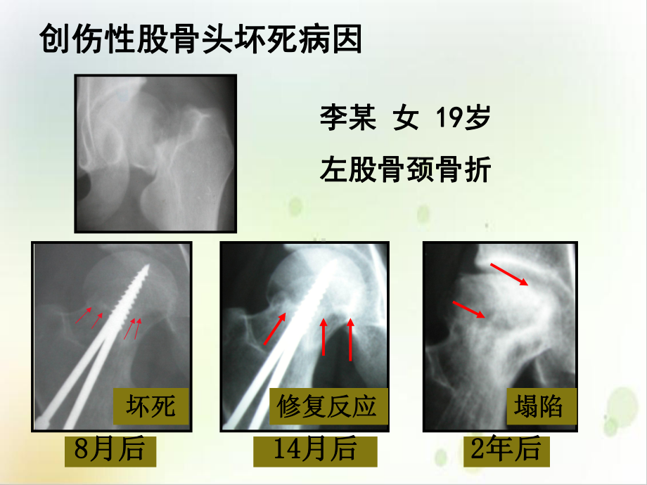 股骨头坏死定义讲课课件.ppt_第3页