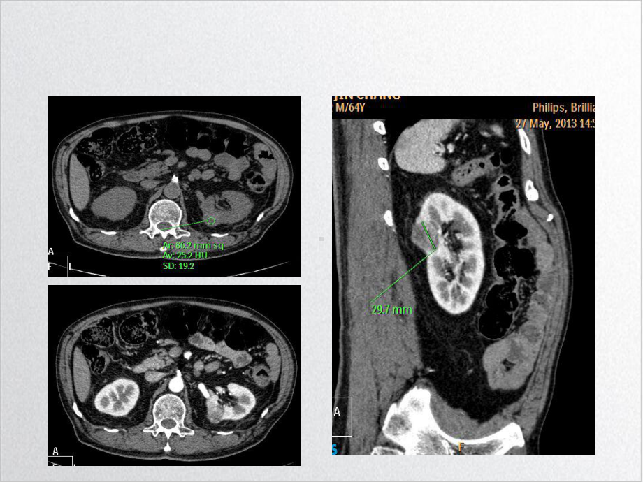 肾癌的表现示范课件.ppt_第3页