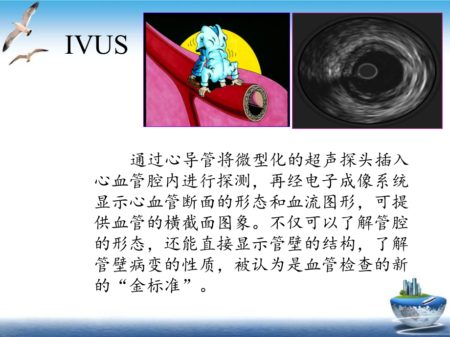 血管内超声IVUS的相关资料示范课件.ppt_第3页