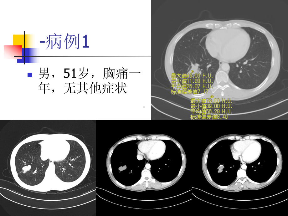 肺结节病变影像学诊断分析课件.ppt_第2页