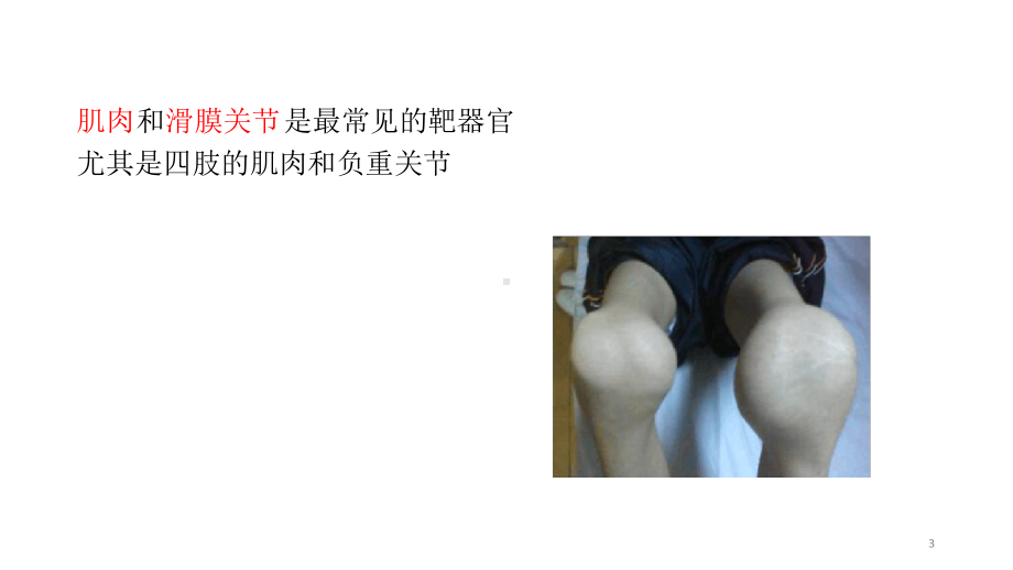 血友病关节炎教学课件.ppt_第3页