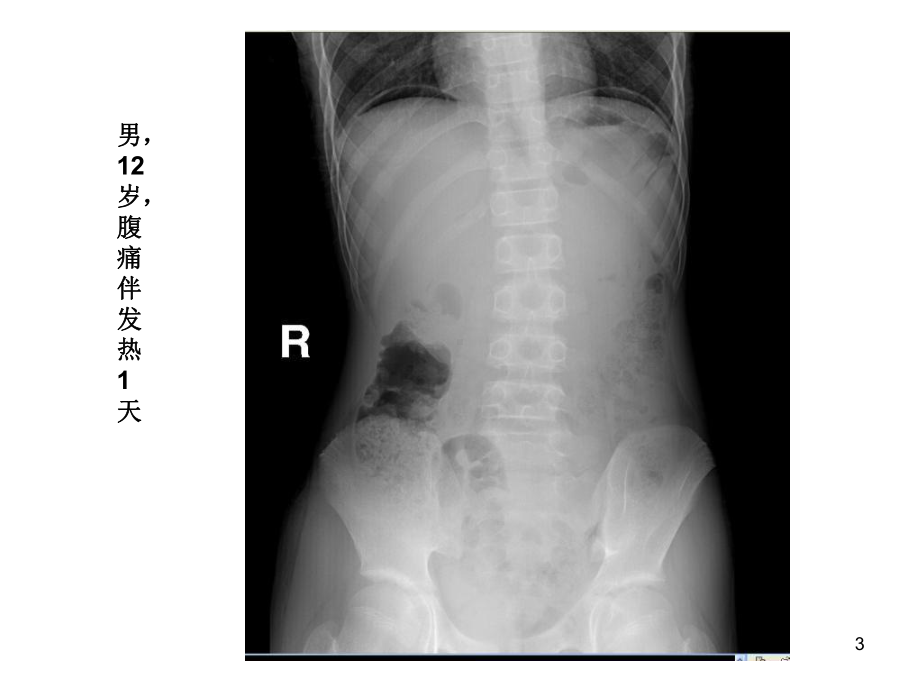 胃肠道常见病多发病张课件.ppt_第3页