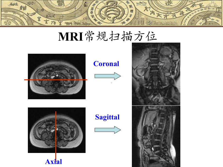 脊柱常见疾病的MRI诊断2课件.ppt_第2页