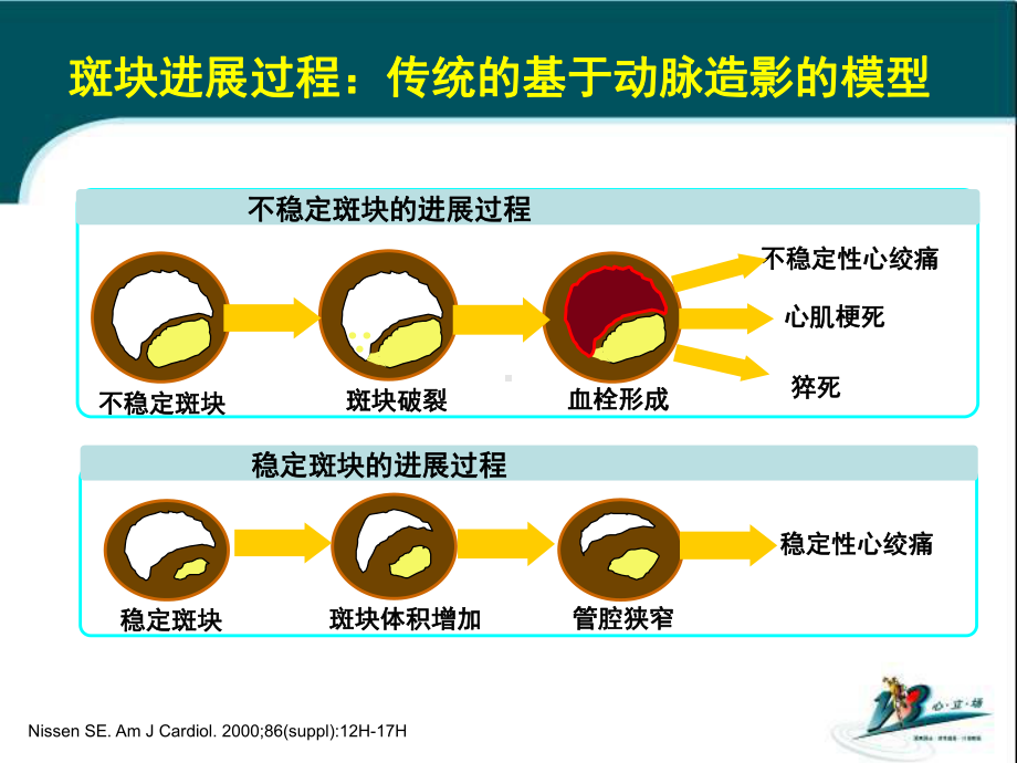 稳定性冠心病患者需要积极降脂治疗课件.pptx_第2页