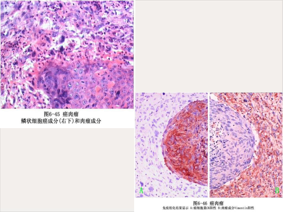 病理解剖学肿瘤三课件.pptx_第3页