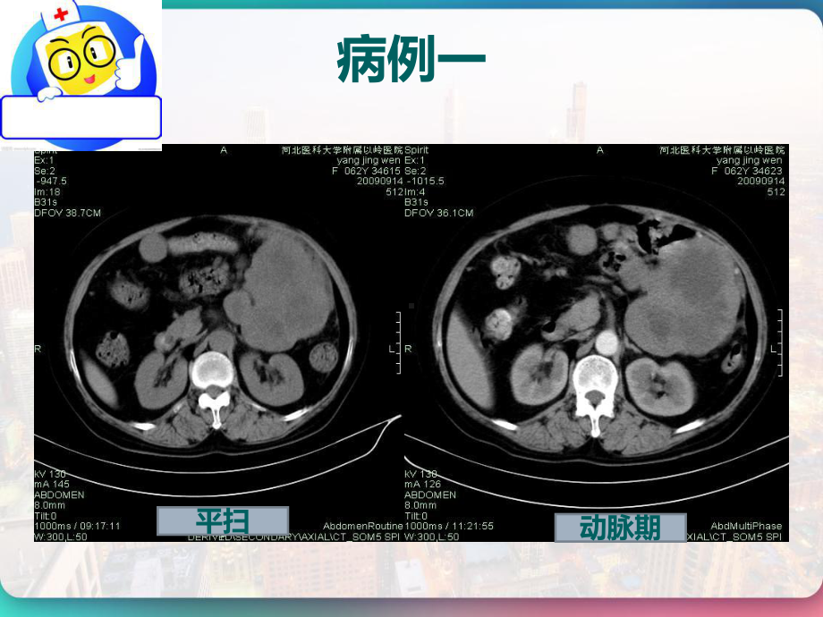 胃肠道间质瘤的影像诊断-课件.pptx_第2页