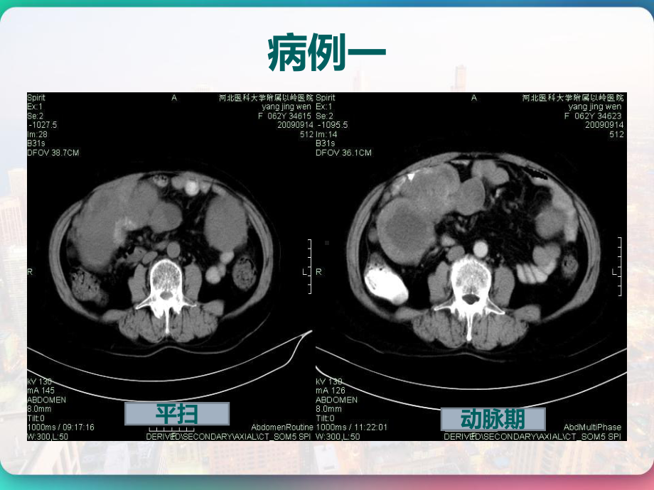 胃肠道间质瘤的影像诊断-课件.pptx_第3页