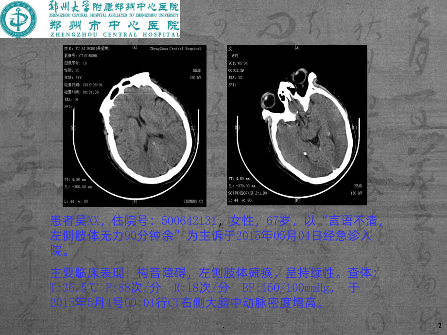 神经系统CT-MRI3课件.ppt_第2页