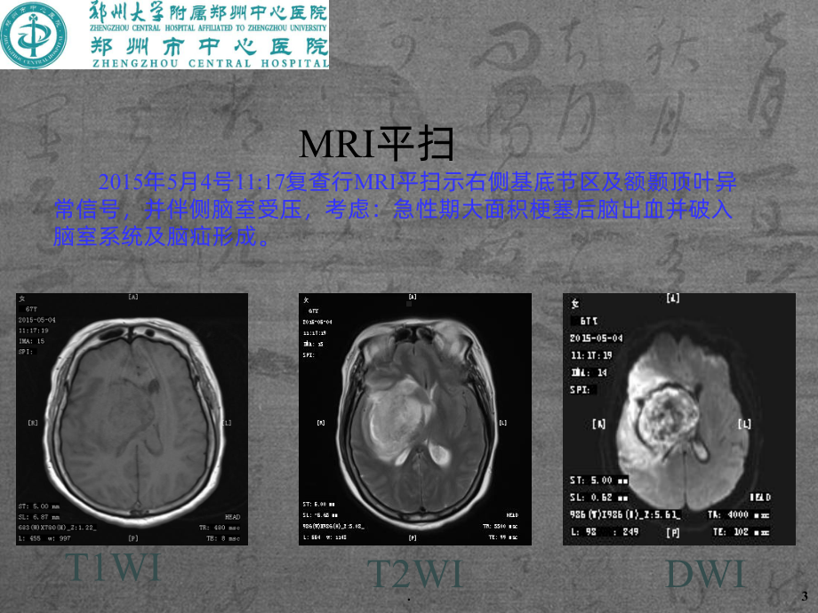 神经系统CT-MRI3课件.ppt_第3页