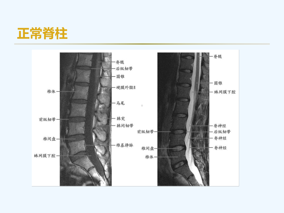 腰椎间盘突出症术后常见并发症观察及护理课件.ppt_第3页