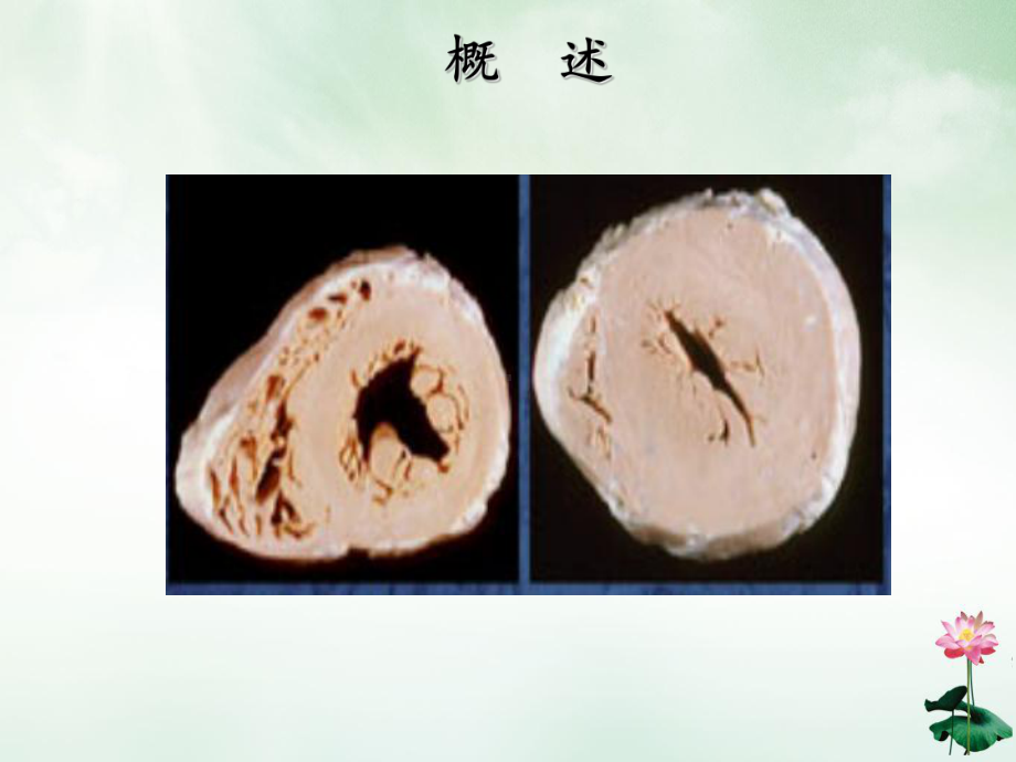 肥厚型梗阻性心肌病的介入治疗修改课件.ppt_第3页