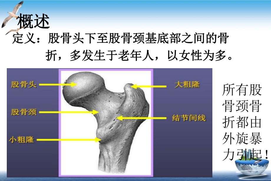 股骨颈骨折护理查房1课件.ppt_第3页